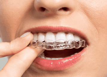 Blanqueamiento Dental