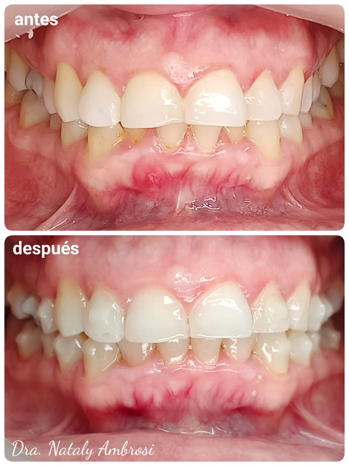 Antes y después - Caso 3