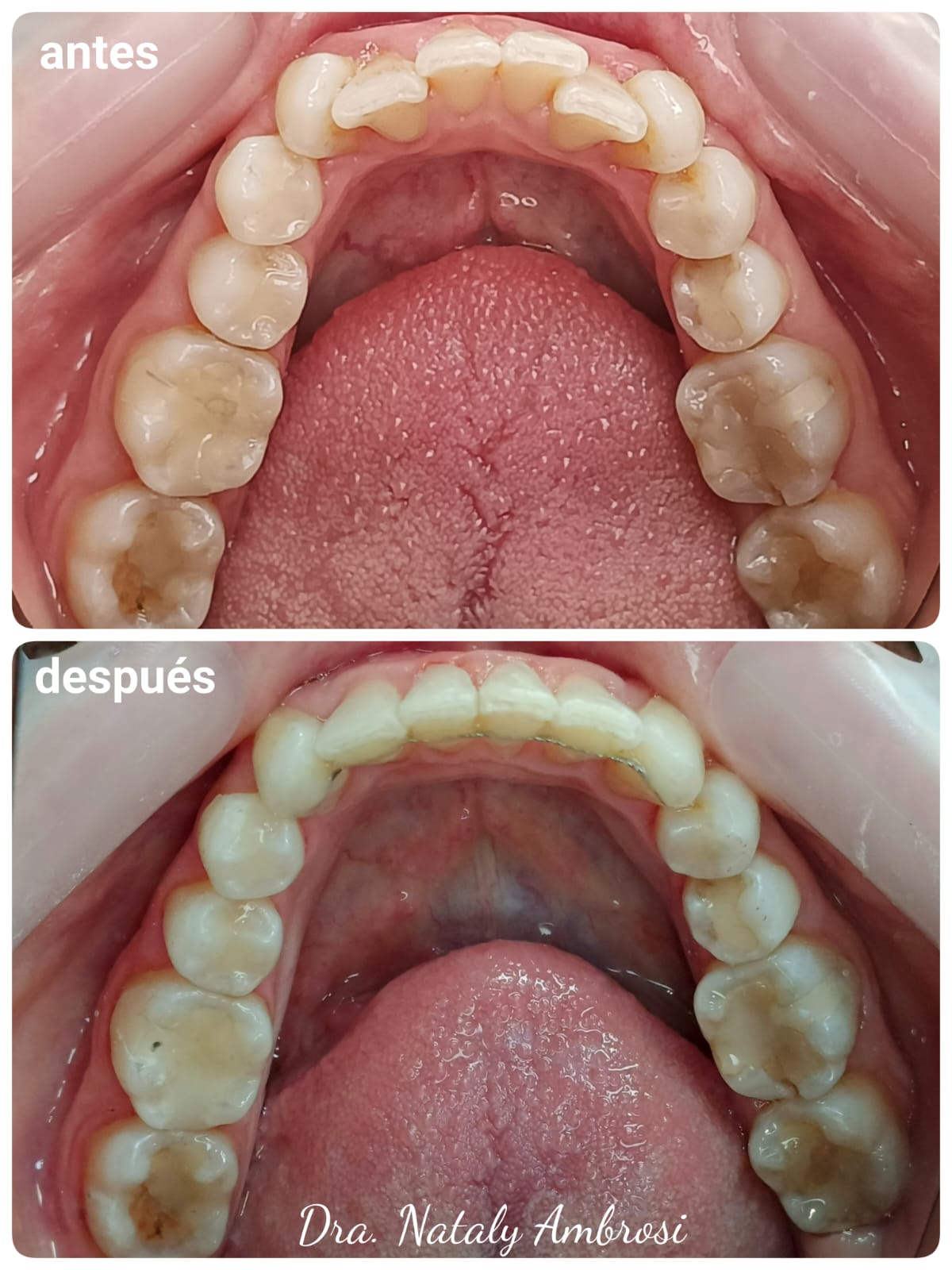 Antes y después - Caso 2