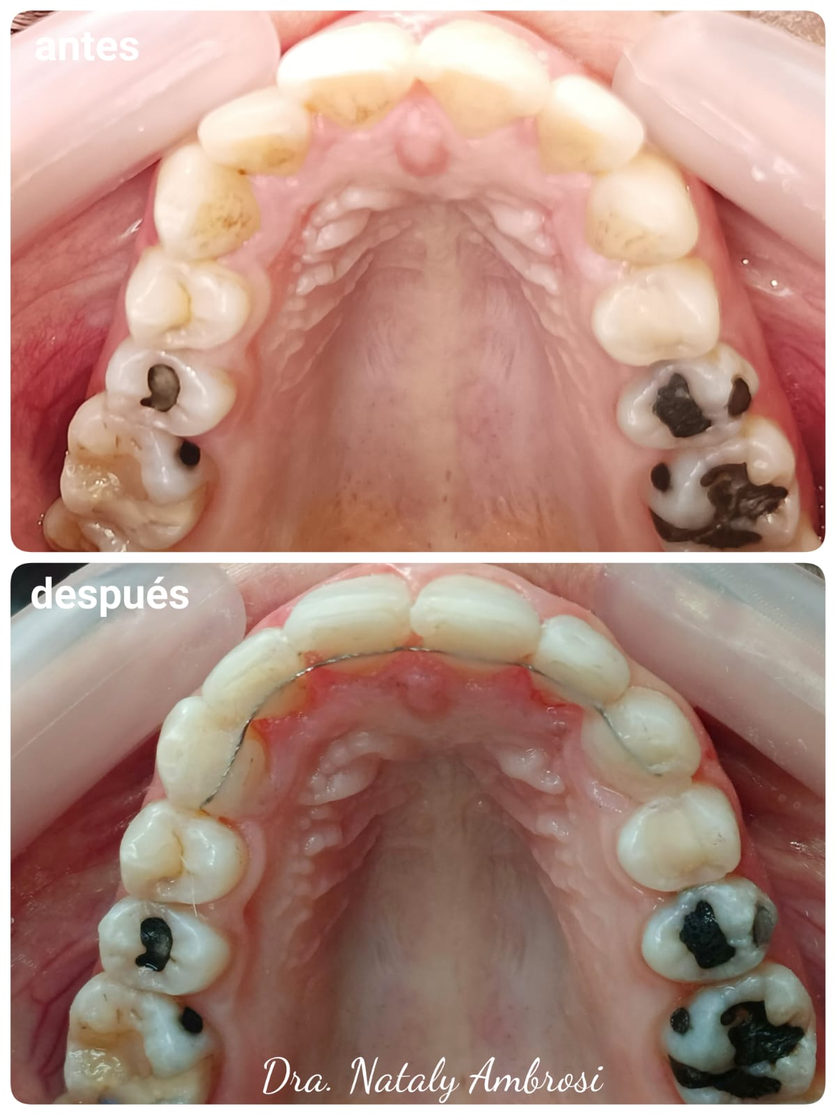 Antes y después - Caso 3