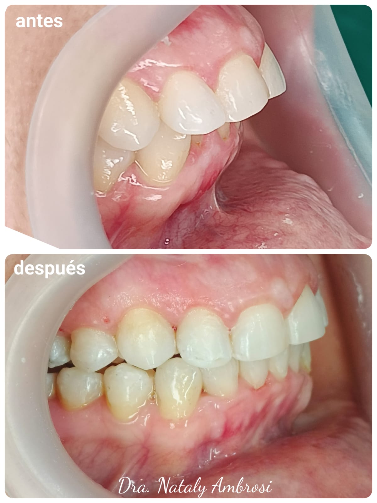 Antes y después - Caso 2